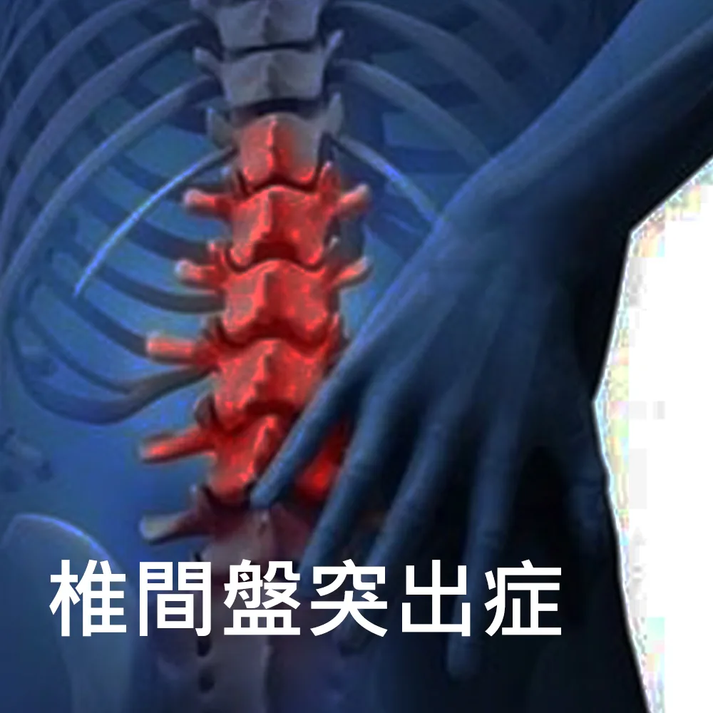 椎間盤突出症